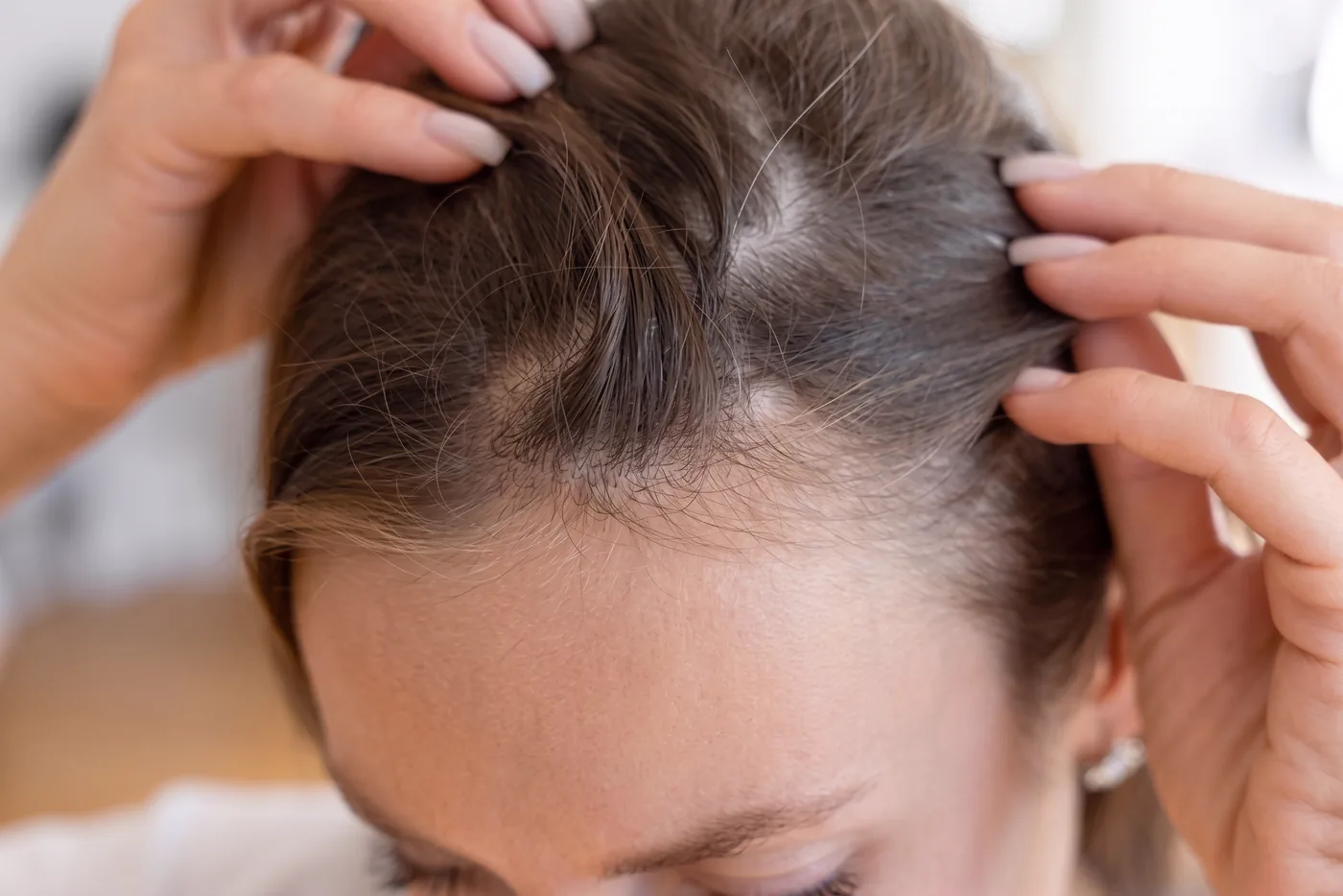 Cuero cabelludo a la vista al separar el cabello